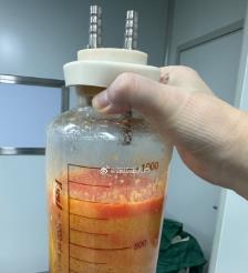 东至水动力吸脂手术要做多久？